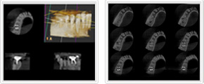 歯根の形態、根尖方向、破折、根管充填の状況なども把握できます。